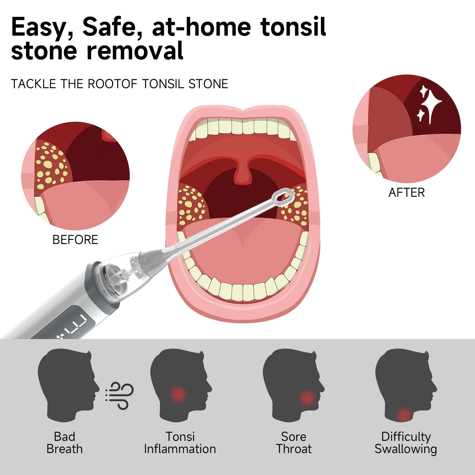 Electronic Tonsil Stone Remover Kit – 5 Suction Modes, LED Light - Image 3